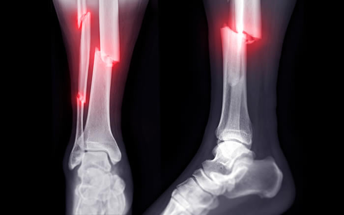 kırık kemik röntgen x ray görüntüsü