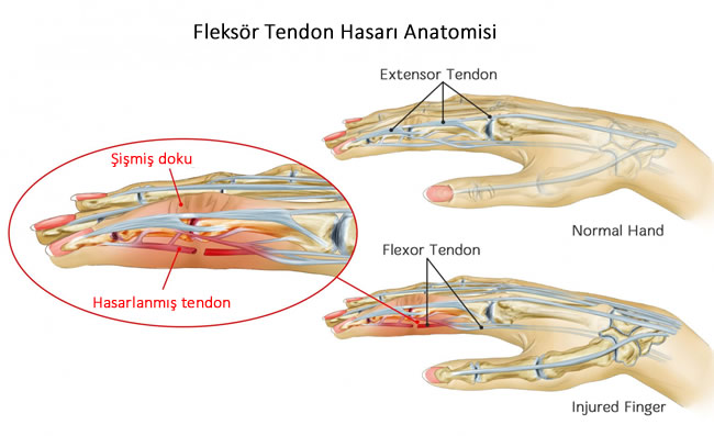 parmak tendon hasarı anatomisi