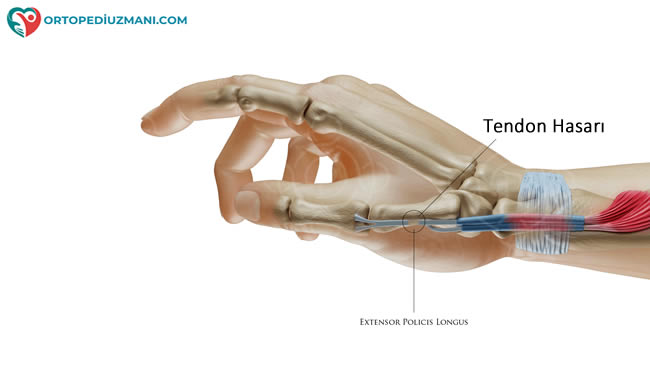 parmak tendon kopması anatomisi